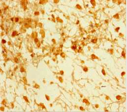 SMAD5 Antibody - Immunohistochemistry of paraffin-embedded human melanoma cancer at dilution 1:100