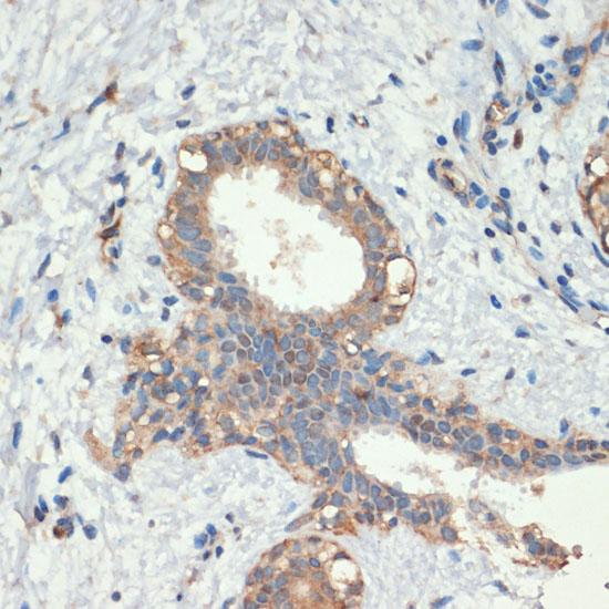 SMAD5 Antibody - Immunohistochemistry of paraffin-embedded Human breast cancer using Smad5 Polyclonal Antibody at dilution of 1:200 (40x lens).