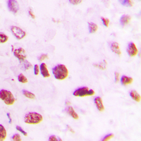 SMAD6 Antibody - Immunohistochemical analysis of SMAD6 staining in human lung cancer formalin fixed paraffin embedded tissue section. The section was pre-treated using heat mediated antigen retrieval with sodium citrate buffer (pH 6.0). The section was then incubated with the antibody at room temperature and detected using an HRP conjugated compact polymer system. DAB was used as the chromogen. The section was then counterstained with hematoxylin and mounted with DPX.