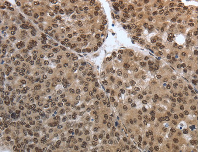 SMAD7 Antibody - Immunohistochemistry of paraffin-embedded Human thyroid cancer using SMAD7 Polyclonal Antibody at dilution of 1:40.