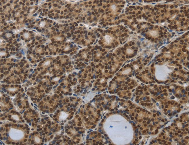 SMAD7 Antibody - Immunohistochemistry of paraffin-embedded Human thyroid cancer using SMAD7 Polyclonal Antibody at dilution of 1:40.