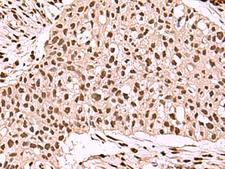SMAD7 Antibody - Immunohistochemistry of paraffin-embedded Human esophagus cancer tissue  using SMAD7 Polyclonal Antibody at dilution of 1:40(×200)