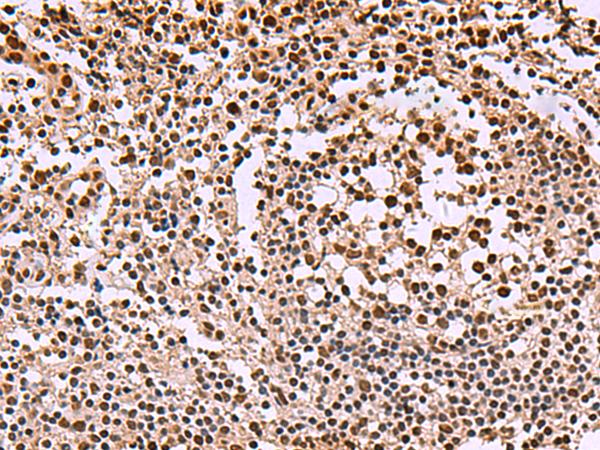 SMAD7 Antibody - Immunohistochemistry of paraffin-embedded Human tonsil tissue  using SMAD7 Polyclonal Antibody at dilution of 1:40(×200)