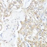 SMAD7 Antibody - Immunohistochemistry of paraffin-embedded Human liver cancer using SMAD7 Polyclonal Antibody at dilution of 1:100 (40x lens).