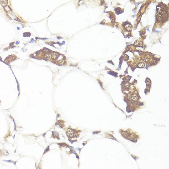 SMAD7 Antibody - Immunohistochemistry of paraffin-embedded Human breast cancer using SMAD7 Polyclonal Antibody at dilution of 1:100 (40x lens).