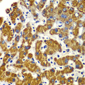 SMAD9 Antibody - Immunohistochemistry of paraffin-embedded human liver injury tissue.