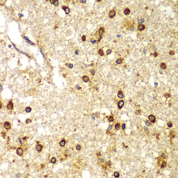 SMAD9 Antibody - Immunohistochemistry of paraffin-embedded human brain cancer tissue.