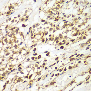 SMAD9 Antibody - Immunohistochemistry of paraffin-embedded human kidney cancer tissue.