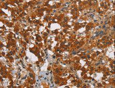 SMAD9 Antibody - Immunohistochemistry of paraffin-embedded Human thyroid cancer using SMAD9 Polyclonal Antibody at dilution of 1:40.