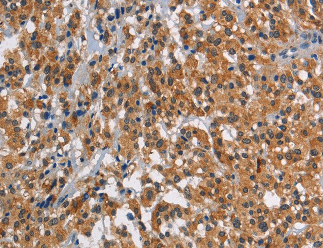 SMAD9 Antibody - Immunohistochemistry of paraffin-embedded Human thyroid cancer using SMAD9 Polyclonal Antibody at dilution of 1:30.