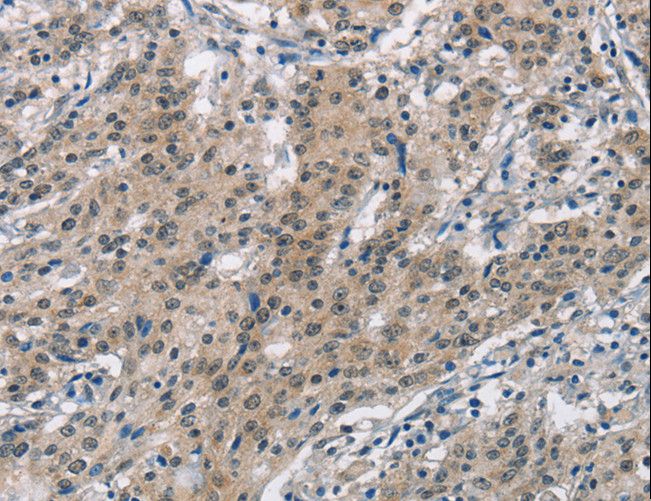 SMAD9 Antibody - Immunohistochemistry of paraffin-embedded Human gastric cancer using SMAD9 Polyclonal Antibody at dilution of 1:30.