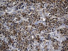 SMAP2 Antibody - Immunohistochemical staining of paraffin-embedded Human lymphoma tissue using anti-SMAP2 mouse monoclonal antibody. (Heat-induced epitope retrieval by 1mM EDTA in 10mM Tris buffer. (pH8.5) at 120°C for 3 min. (1:500)