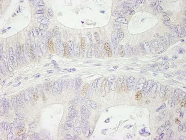 SMARCA1 / SWI Antibody - Detection of Human SMARCA1/SNF2L by Immunohistochemistry. Sample: FFPE section of human colon carcinoma. Antibody: Affinity purified rabbit anti-SMARCA1/SNF2L used at a dilution of 1:500.