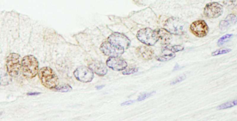 SMARCA1 / SWI Antibody - Detection of Human SMARCA1/SNF2L by Immunohistochemistry. Sample: FFPE section of human prostate carcinoma. Antibody: Affinity purified rabbit anti-SMARCA1/SNF2L used at a dilution of 1:5000 (0.2 ug/ml). Detection: DAB.