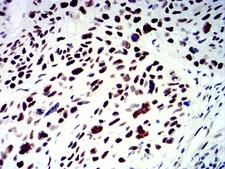 SMARCA1 / SWI Antibody - Immunohistochemical analysis of paraffin-embedded esophageal cancer tissues using SMARCA1 mouse mAb with DAB staining.