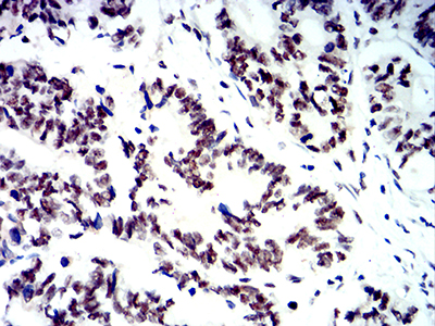 SMARCA1 / SWI Antibody - Immunohistochemical analysis of paraffin-embedded rectum cancer tissues using SMARCA1 mouse mAb with DAB staining.