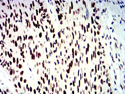 SMARCA1 / SWI Antibody - Immunohistochemical analysis of paraffin-embedded esophageal cancer tissues using SMARCA1 mouse mAb with DAB staining.