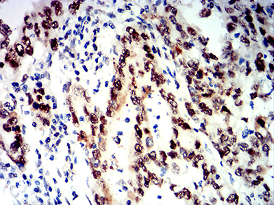 SMARCA1 / SWI Antibody - Immunohistochemical analysis of paraffin-embedded stomach cancer tissues using SMARCA1 mouse mAb with DAB staining.