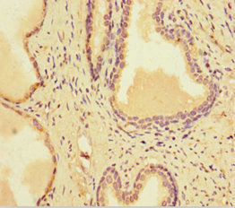 SMARCA1 / SWI Antibody - Immunohistochemistry of paraffin-embedded human prostate cancer at dilution of 1:100