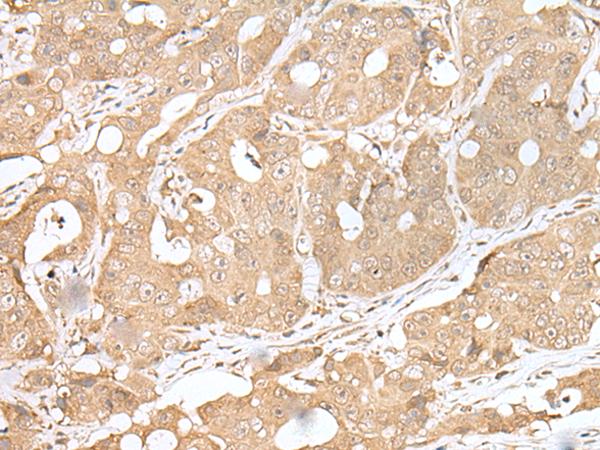 SMARCA1 / SWI Antibody - Immunohistochemistry of paraffin-embedded Human gastric cancer tissue  using SMARCA1 Polyclonal Antibody at dilution of 1:30(×200)