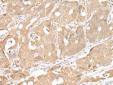 SMARCA1 / SWI Antibody - Immunohistochemistry of paraffin-embedded Human gastric cancer tissue  using SMARCA1 Polyclonal Antibody at dilution of 1:30(×200)