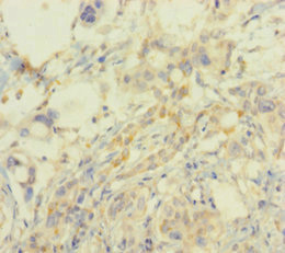 SMARCA2 / BRM Antibody - Immunohistochemistry of paraffin-embedded human pancreatic cancer using SMARCA2 Antibody at dilution of 1:100
