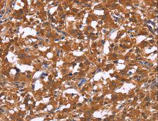 SMARCA3 / HLTF Antibody - Immunohistochemistry of paraffin-embedded Human gastric cancer using HLTF Polyclonal Antibody at dilution of 1:30.