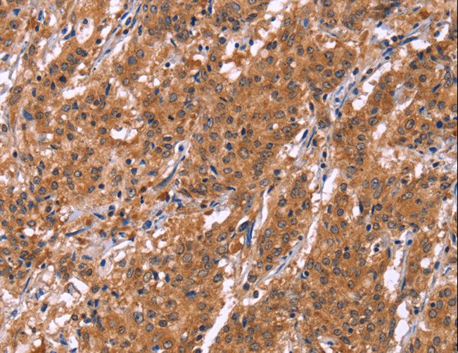 SMARCA3 / HLTF Antibody - Immunohistochemistry of paraffin-embedded Human gastric cancer using HLTF Polyclonal Antibody at dilution of 1:30.