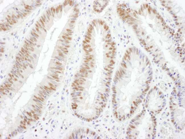 SMARCA4 / BRG1 Antibody - Detection of Human BRG1 by Immunohistochemistry. Sample: FFPE section of human colon carcinoma. Antibody: Affinity purified rabbit anti-BRG1 used at a dilution of 1:1000 (1 ug/ml). Detection: DAB.
