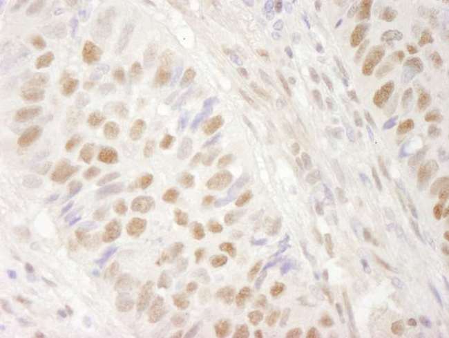 SMARCA4 / BRG1 Antibody - Detection of Human BRG1/SMARCA4 by Immunohistochemistry. Sample: FFPE section of human non-small cell lung cancer. Antibody: Affinity purified rabbit anti-BRG1/SMARCA4 used at a dilution of 1:250. Epitope Retrieval Buffer-High pH (IHC-101J) was substituted for Epitope Retrieval Buffer-Reduced pH.