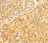 SMARCA4 / BRG1 Antibody - Immunohistochemistry of paraffin-embedded human lung cancer at dilution 1:100