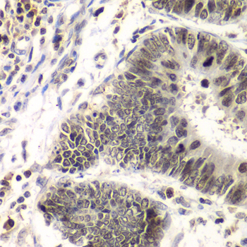 SMARCA4 / BRG1 Antibody - Immunohistochemistry of paraffin-embedded human colon carcinoma using SMARCA4 antibody at dilution of 1:100 (40x lens).