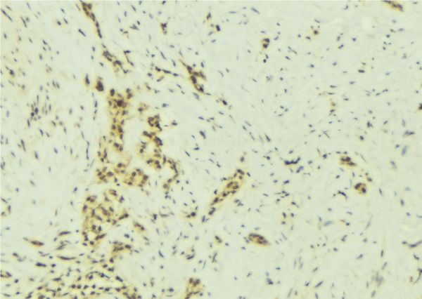 SMARCA5 / SNF2H Antibody - 1:100 staining human breast carcinoma tissue by IHC-P. The sample was formaldehyde fixed and a heat mediated antigen retrieval step in citrate buffer was performed. The sample was then blocked and incubated with the antibody for 1.5 hours at 22°C. An HRP conjugated goat anti-rabbit antibody was used as the secondary.