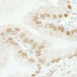 SMARCB1 / INI1 Antibody - Detection of Human SMARCB1/SNF5 by Immunohistochemistry. Sample: FFPE section of human prostate carcinoma. Antibody: Affinity purified rabbit anti-SMARCB1/SNF5 used at a dilution of 1:250.