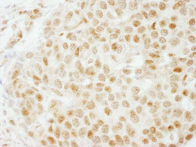 SMARCB1 / INI1 Antibody - Detection of Human SMARCB1/SNF5 by Immunohistochemistry. Sample: FFPE section of human breast carcinoma. Antibody: Affinity purified rabbit anti-SMARCB1/SNF5 used at a dilution of 1:1000 (1 ug/ml). Detection: DAB.
