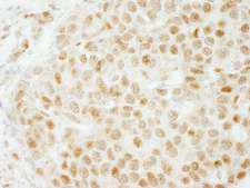 SMARCB1 / INI1 Antibody - Detection of Human SMARCB1/SNF5 by Immunohistochemistry. Sample: FFPE section of human breast carcinoma. Antibody: Affinity purified rabbit anti-SMARCB1/SNF5 used at a dilution of 1:1000 (1 ug/ml). Detection: DAB.