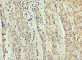 SMARCB1 / INI1 Antibody - Immunohistochemistry of paraffin-embedded human rectal cancer using antibody at 1:100 dilution.