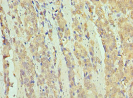 SMARCB1 / INI1 Antibody - Immunohistochemistry of paraffin-embedded human colon cancer using SMARCB1 Antibody at dilution of 1:100