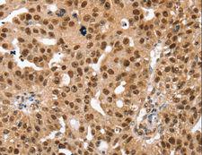 SMARCB1 / INI1 Antibody - Immunohistochemistry of paraffin-embedded Human breast cancer using SMARCB1 Polyclonal Antibody at dilution of 1:30.