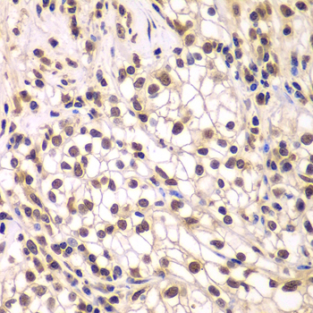 SMARCC1 / SWI3 Antibody - Immunohistochemistry of paraffin-embedded human kidney cancer tissue.