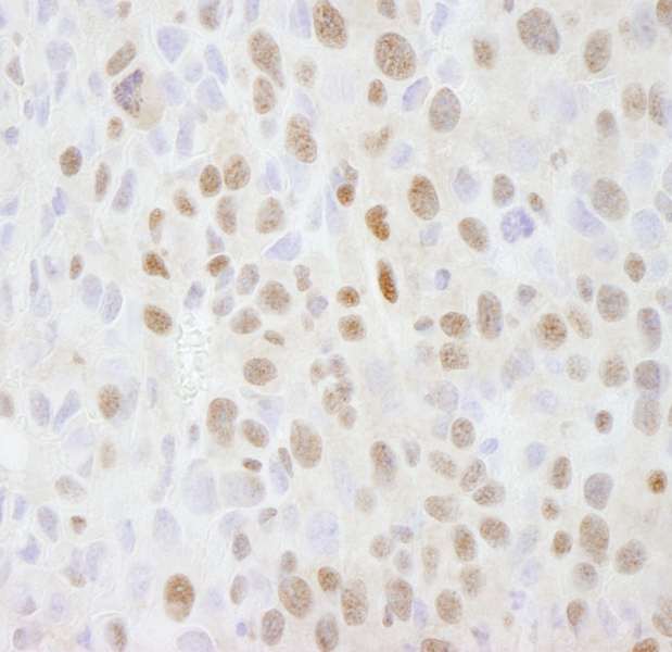 SMARCC2 Antibody - Detection of Mouse SMARCC2/BAF170 by Immunohistochemistry. Sample: FFPE section of mouse squamous cell carcinoma. Antibody: Affinity purified rabbit anti-SMARCC2/BAF170 used at a dilution of 1:500.