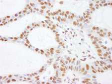 SMARCC2 Antibody - Detection of Human SMARCC2/BAF170 by Immunohistochemistry. Sample: FFPE section of human skin basal cell carcinoma. Antibody: Affinity purified rabbit anti-SMARCC2/BAF170 used at a dilution of 1:200 (1 ug/ml). Detection: DAB.