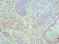 SMARCC2 Antibody - Immunohistochemistry of paraffin-embedded human rectal cancer using antibody at 1:100 dilution.