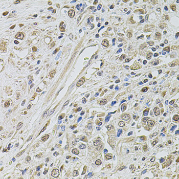 SMARCC2 Antibody - Immunohistochemistry of paraffin-embedded human prostate cancer tissue.