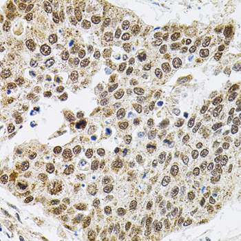 SMARCD1 / BAF60A Antibody - Immunohistochemistry of paraffin-embedded human lung cancer tissue.