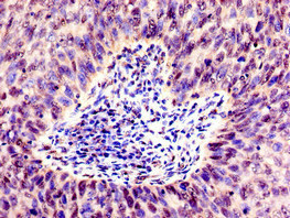 SMARCD1 / BAF60A Antibody - Immunohistochemistry image of paraffin-embedded human cervical cancer at a dilution of 1:100