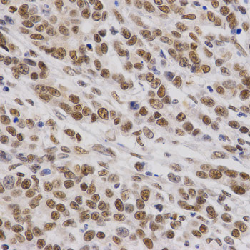 SMARCE1 / BAF57 Antibody - Immunohistochemistry of paraffin-embedded human stomach cancer tissue.
