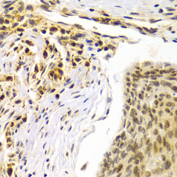SMARCE1 / BAF57 Antibody - Immunohistochemistry of paraffin-embedded human esophageal cancer tissue.
