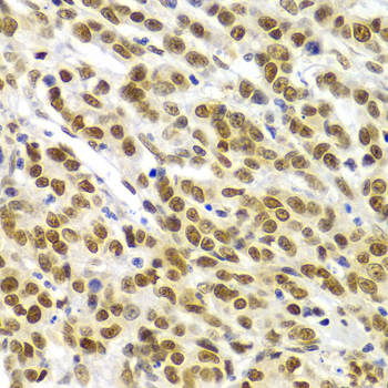 SMARCE1 / BAF57 Antibody - Immunohistochemistry of paraffin-embedded Human gastric cancer tissue.