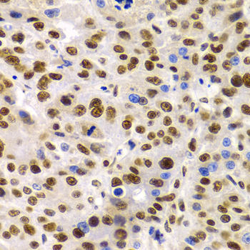 SMARCE1 / BAF57 Antibody - Immunohistochemistry of paraffin-embedded liver cancer tissue.